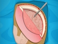 Operate Now: Epilepsy Surgery online game
