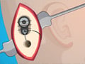 Operate Now: Ear Surgery online hra