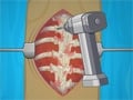 Operate Now: Scoliosis Surgery